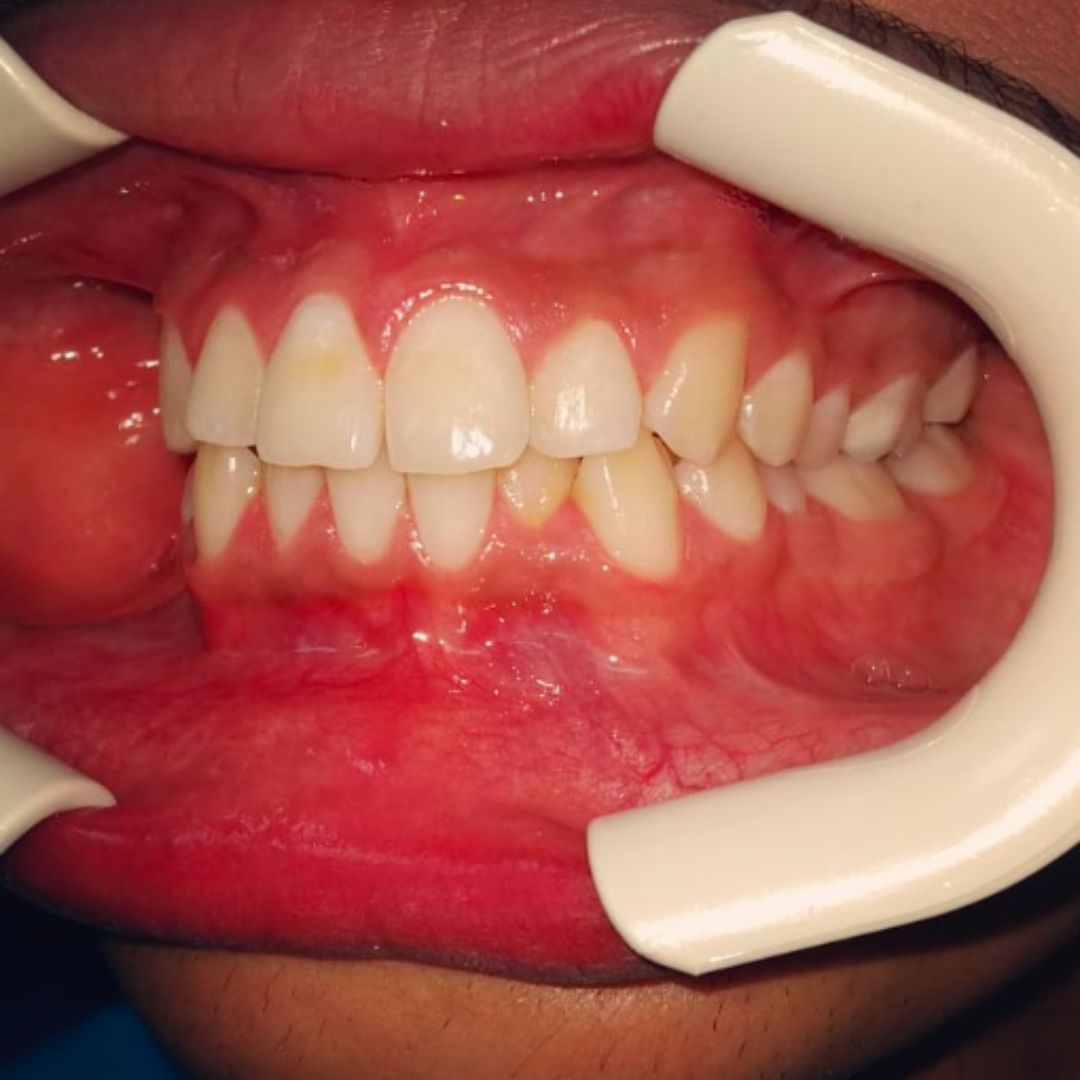 Self Ligating Braces Dental Clinic in Dubai Orthodontist